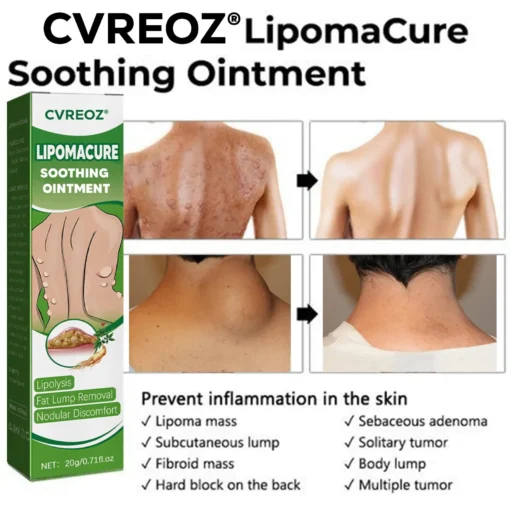 Cvreoz® LipomaCure Soothing Ointment