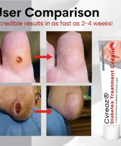 Cvreoz® Natural Lipoma Removal Cream