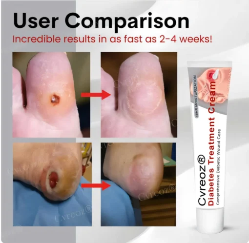 Cvreoz® Natural Lipoma Removal Cream