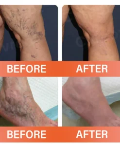 Cvreoz® VeinEase Microneedle Therapy Patch