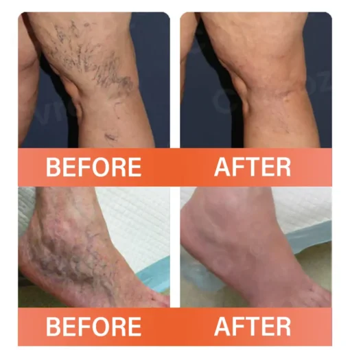 Cvreoz® VeinEase Microneedle Therapy Patch