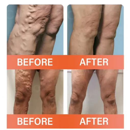 Cvreoz® VeinEase Microneedle Therapy Patch