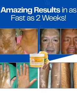 Cvreoz® VitiClear Bee Venom Cream