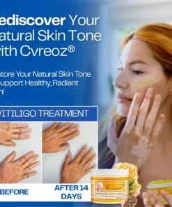 Cvreoz® VitiClear Bee Venom Cream