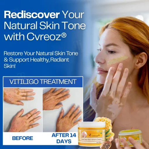 Cvreoz® VitiClear Bee Venom Cream