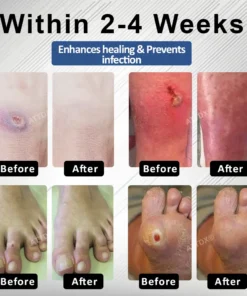 CVREOZ® Diabetes Foot Guard Fast Recovery Spray