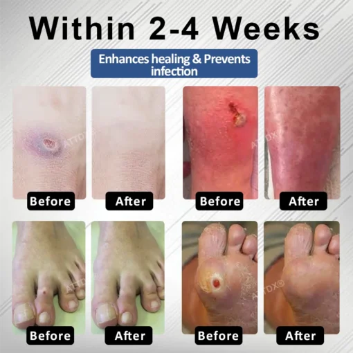 CVREOZ® Diabetes Foot Guard Fast Recovery Spray