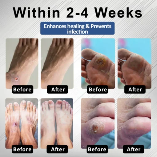 CVREOZ® Diabetes Foot Guard Fast Recovery Spray