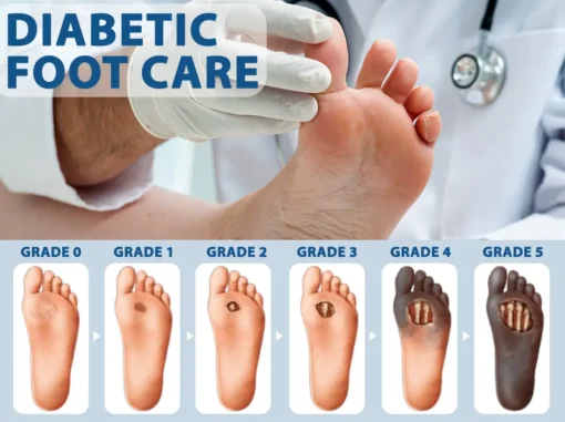 CVREOZ® Diabetes Foot Guard Fast Recovery Spray