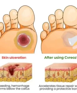 CVREOZ® Diabetic's Foot Cream