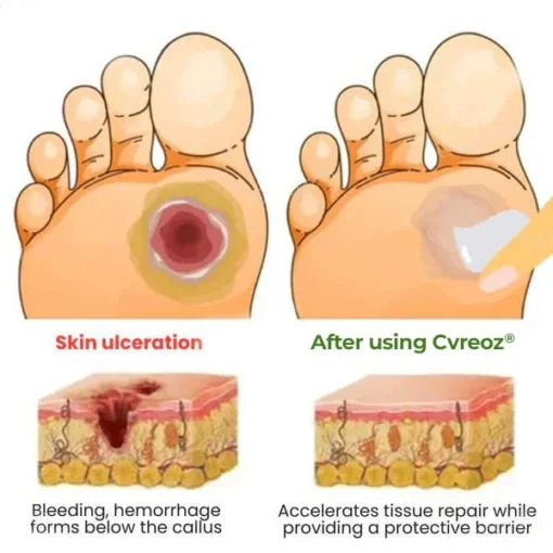 CVREOZ® Diabetic's Foot Cream