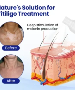CVREOZ® Vitiligo Herbal Spray