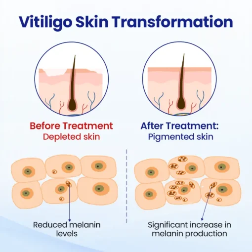 CVREOZ® Vitiligo Herbal Spray