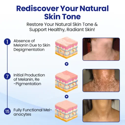 CVREOZ® Vitiligo Herbal Spray