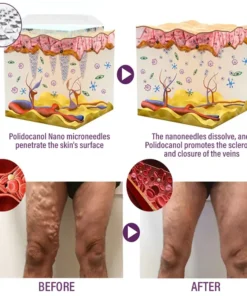 Crveoz® NanoPoli Varicose Vein Patch