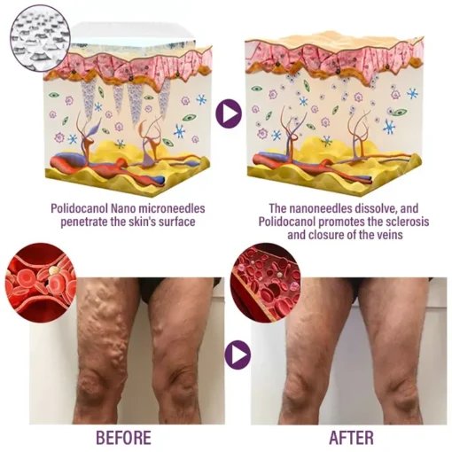 Crveoz® NanoPoli Varicose Vein Patch