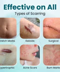 Cvreoz® Advanced Scar Gel