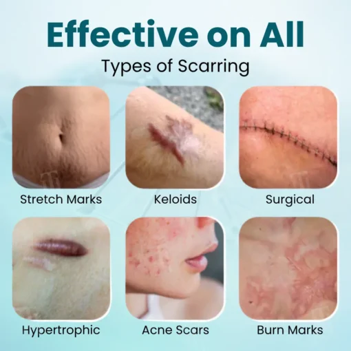 Cvreoz® Advanced Scar Gel