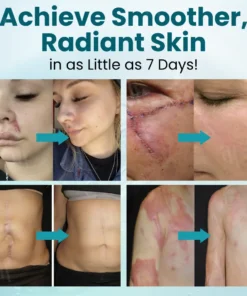 Cvreoz® Advanced Scar Gel