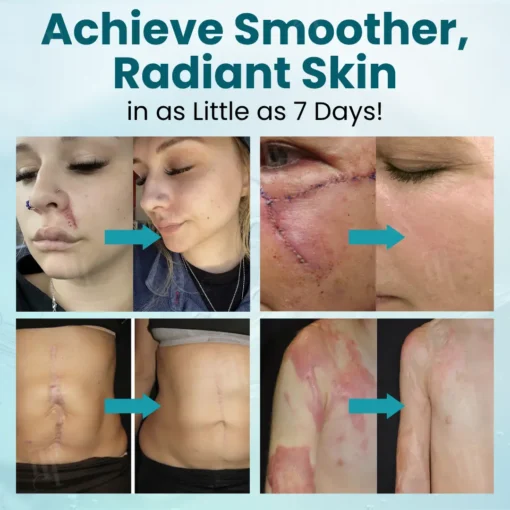 Cvreoz® Advanced Scar Gel