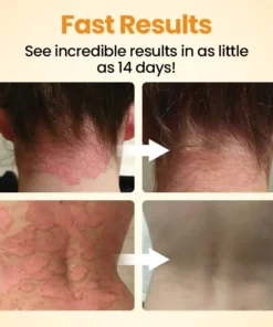 Cvreoz® BeeLief Psoriasis Skin Care Cream