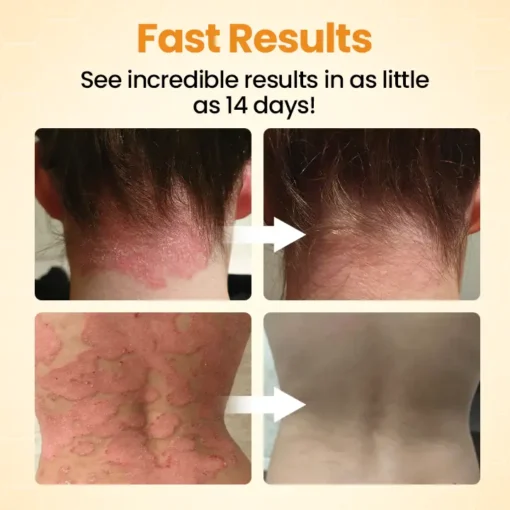 Cvreoz® BeeLief Psoriasis Skin Care Cream