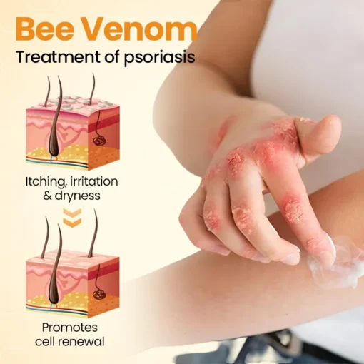 Cvreoz® BeeLief Psoriasis Skin Care Cream