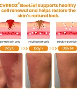 Cvreoz® BeeLief Psoriasis Skin Care Cream