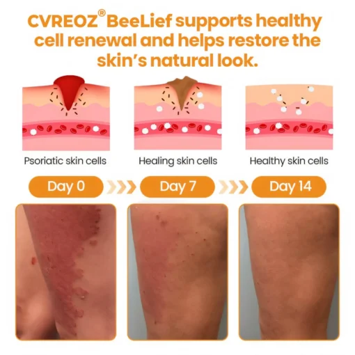 Cvreoz® BeeLief Psoriasis Skin Care Cream