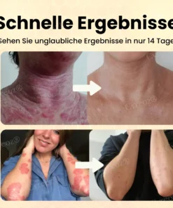 Cvreoz® Bienengift Psoriasis Behandlung Creme