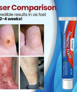 Cvreoz® Diabetic Foot Ulcer Repair Cream