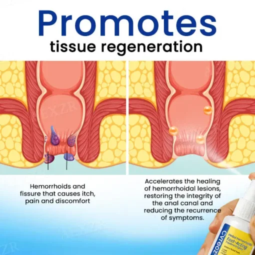 Cvreoz® Herbal Hemorrhoids Fast-Acting Treatment Spray