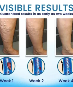 Cvreoz® Herbal Varicose Veins Treatment Spray