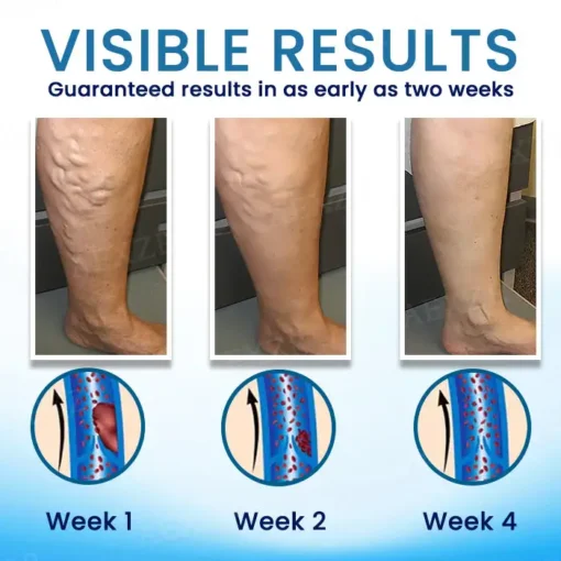Cvreoz® Herbal Varicose Veins Treatment Spray