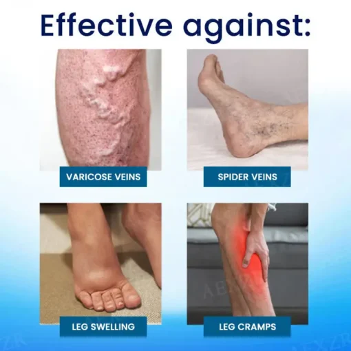 Cvreoz® Herbal Varicose Veins Treatment Spray