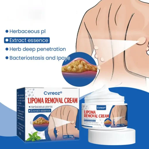 Cvreoz® Lipoma Removal Cream