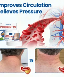 Cvreoz® Lipoma Removal Cream