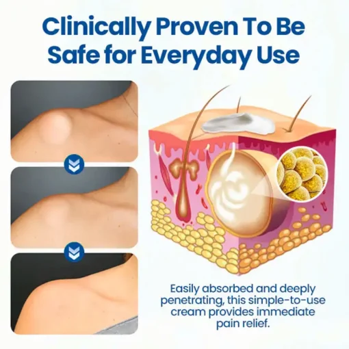 Cvreoz® Lipoma Removal Cream