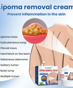 Cvreoz® Lipoma Removal Cream