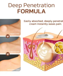 Cvreoz® Lumpless Lipoma Treatment Cream
