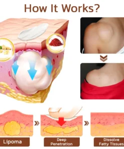 Cvreoz® Lumpless Lipoma Treatment Cream