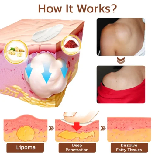 Cvreoz® Lumpless Lipoma Treatment Cream