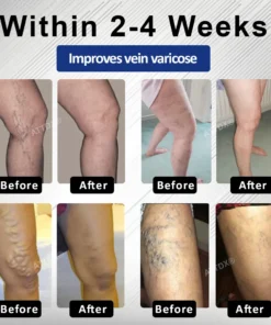 Cvreoz® MagniLift VeinErase Spray