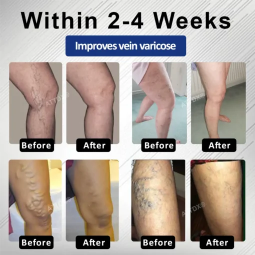 Cvreoz® MagniLift VeinErase Spray