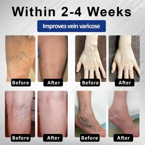 Cvreoz® MagniLift VeinErase Spray
