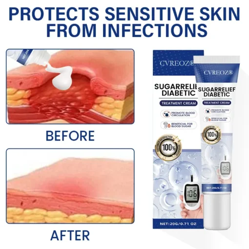 Cvreoz® SugarRelief Diabetic Treatment Cream