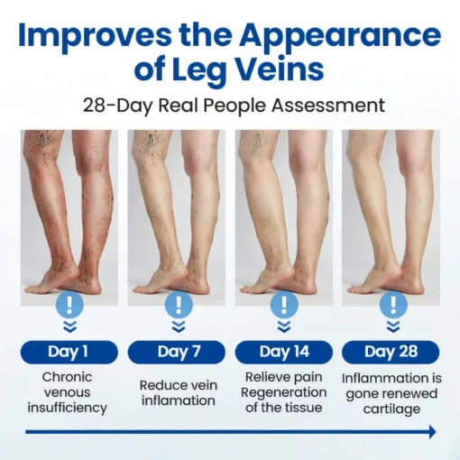 Cvreoz® Varicose Veins Patch