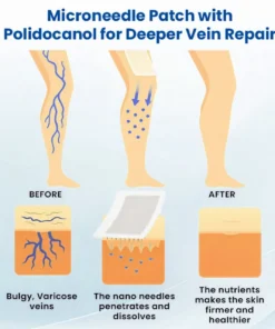 Cvreoz® Varicose Veins Patch