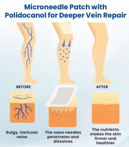 Cvreoz® Varicose Veins Patch