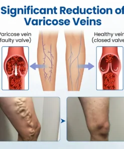 Cvreoz® Varicose Veins Patch